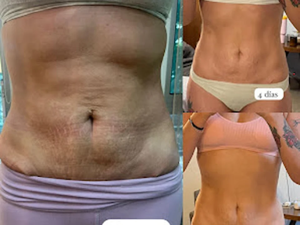 Regenerativa. Desvanecer Estrías. Fibrosis post Liposucción, Ciudad de México